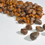 kolkata-medical-college-record-gallstones