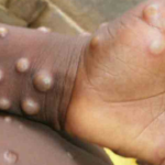 the new Mpox outbreak in India