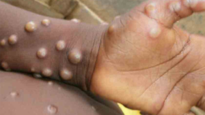 the new Mpox outbreak in India