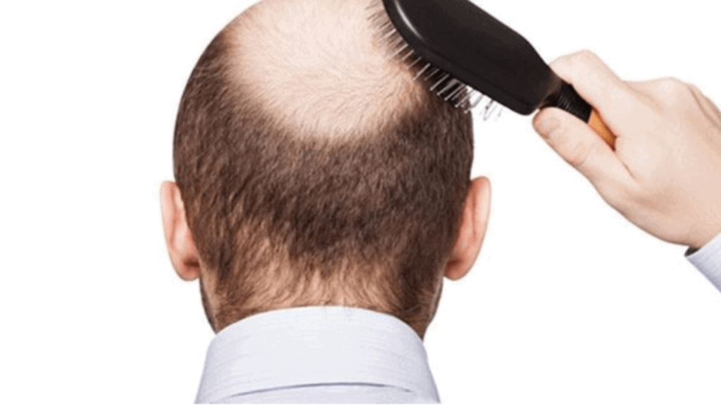 premature-hair-loss-care-mistakes