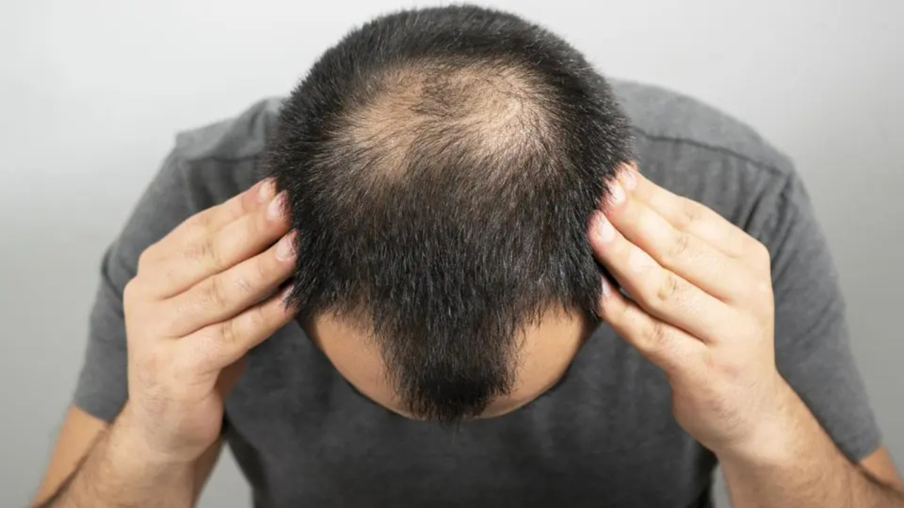 চুল পড়ে যাওয়ার সমস্যায় ভুগছেন