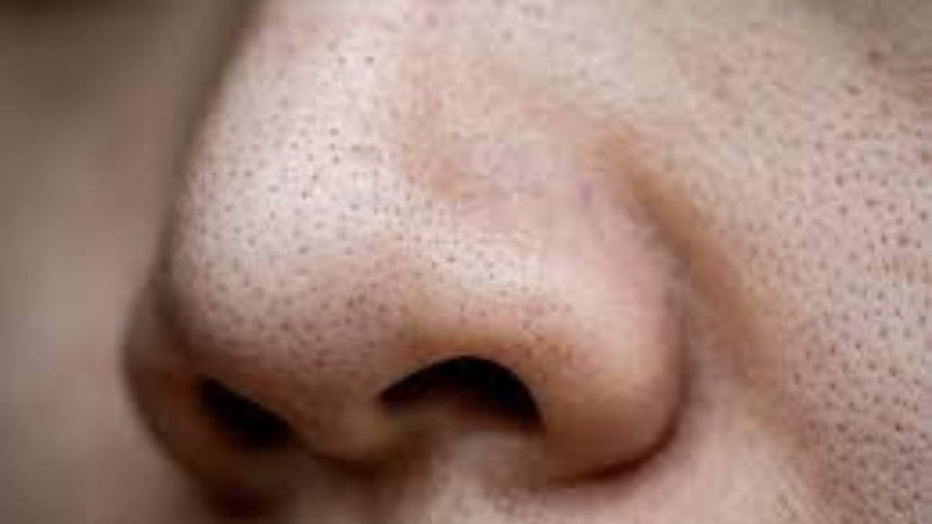 ব্ল্যাকহেডস