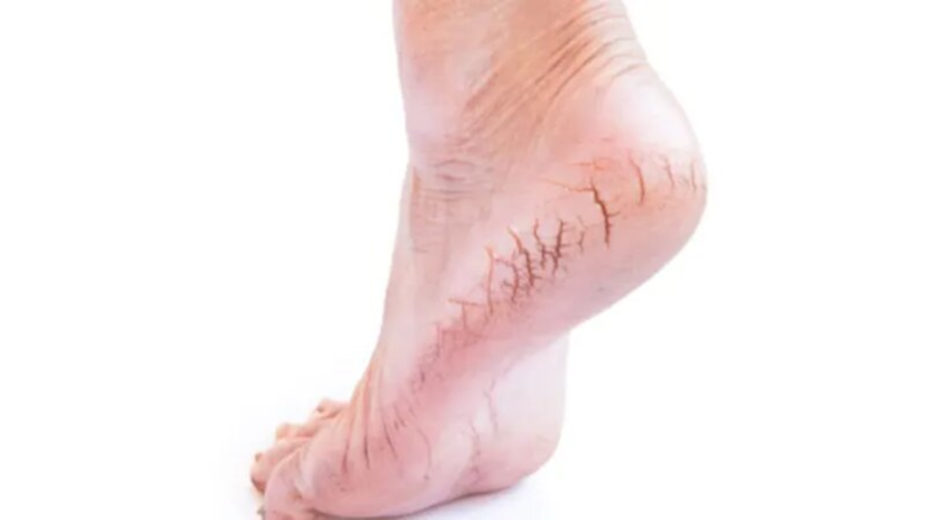 পায়ের গোড়ালি ফেটে