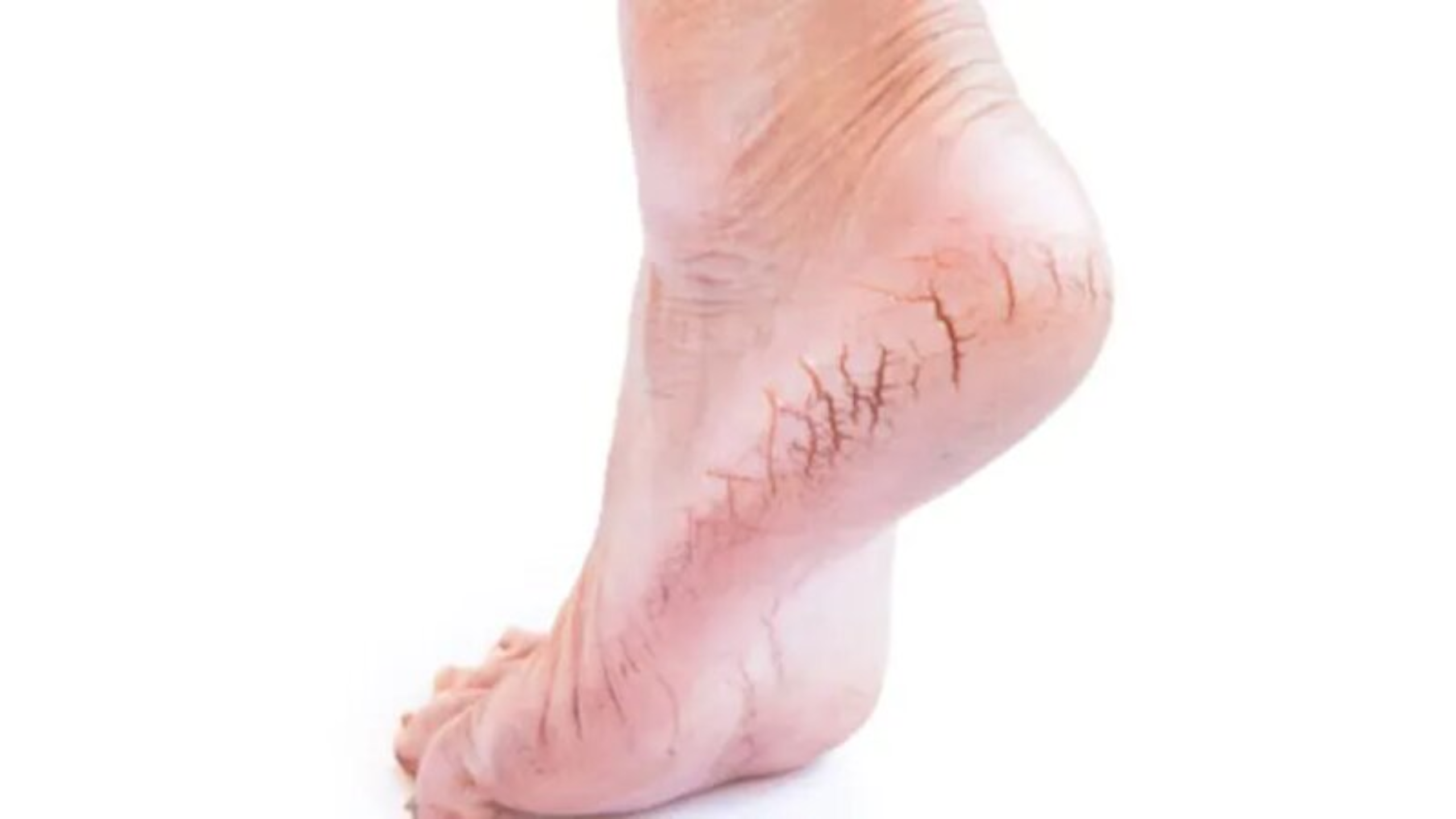 পায়ের গোড়ালি ফেটে