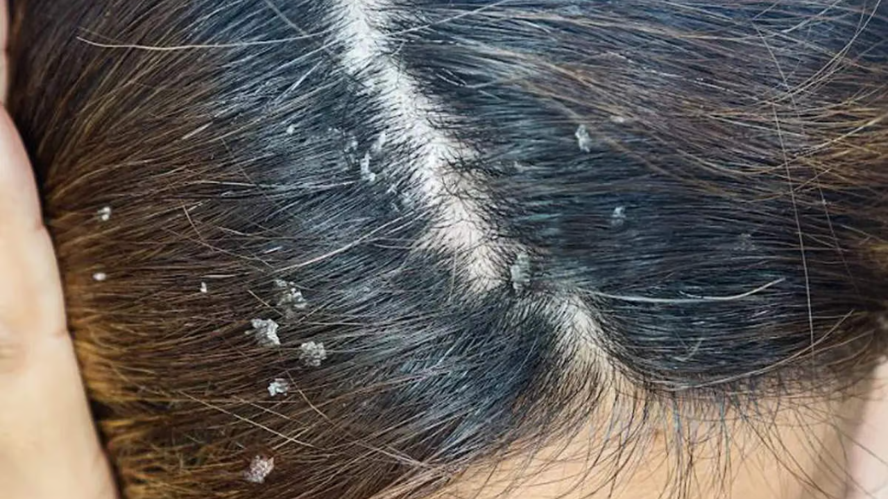 চুলের সমস্যা কি আপনার ব্রণ হওয়ার কারণ?