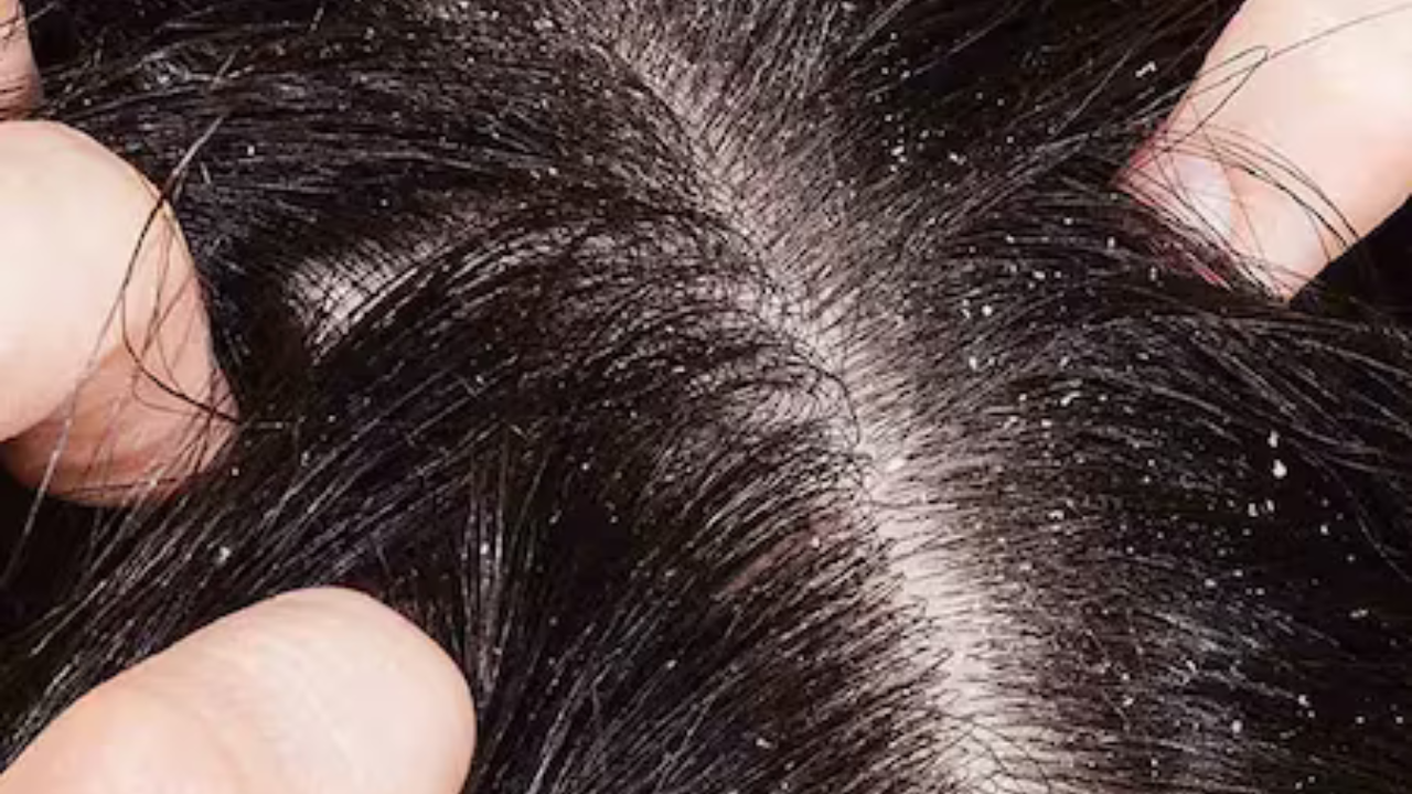 শীতে খুশকির সমস্যায় নাজেহাল