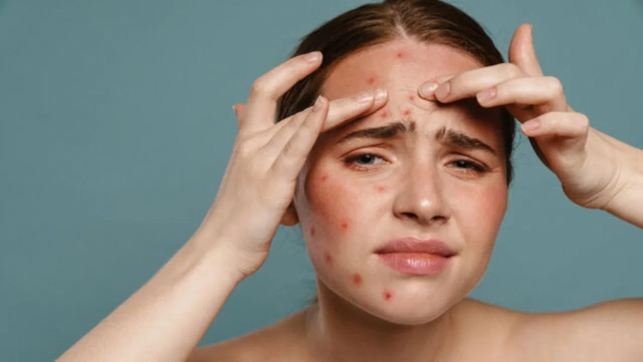 ব্রণ সমস্যায় ভুগছেন? কারণ হতে পারে আপনার চুলের সমস্যা