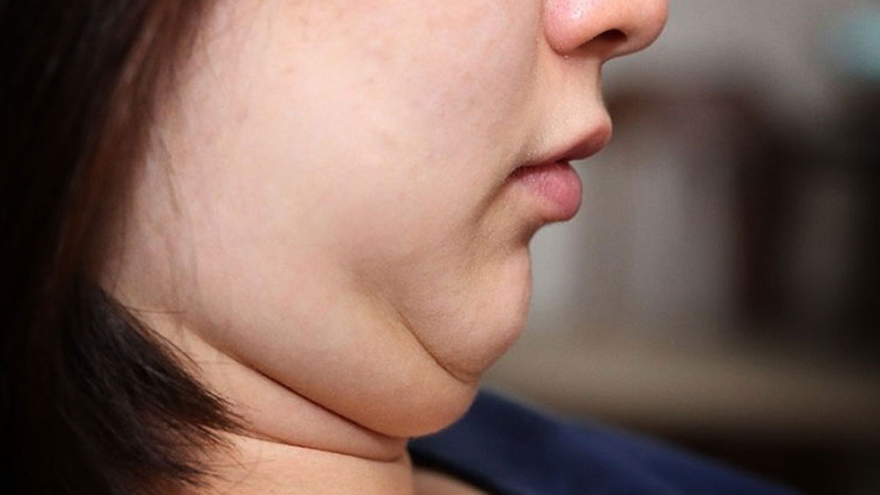 ডাবল চিন দূর করার সহজ ঘরোয়া উপায়