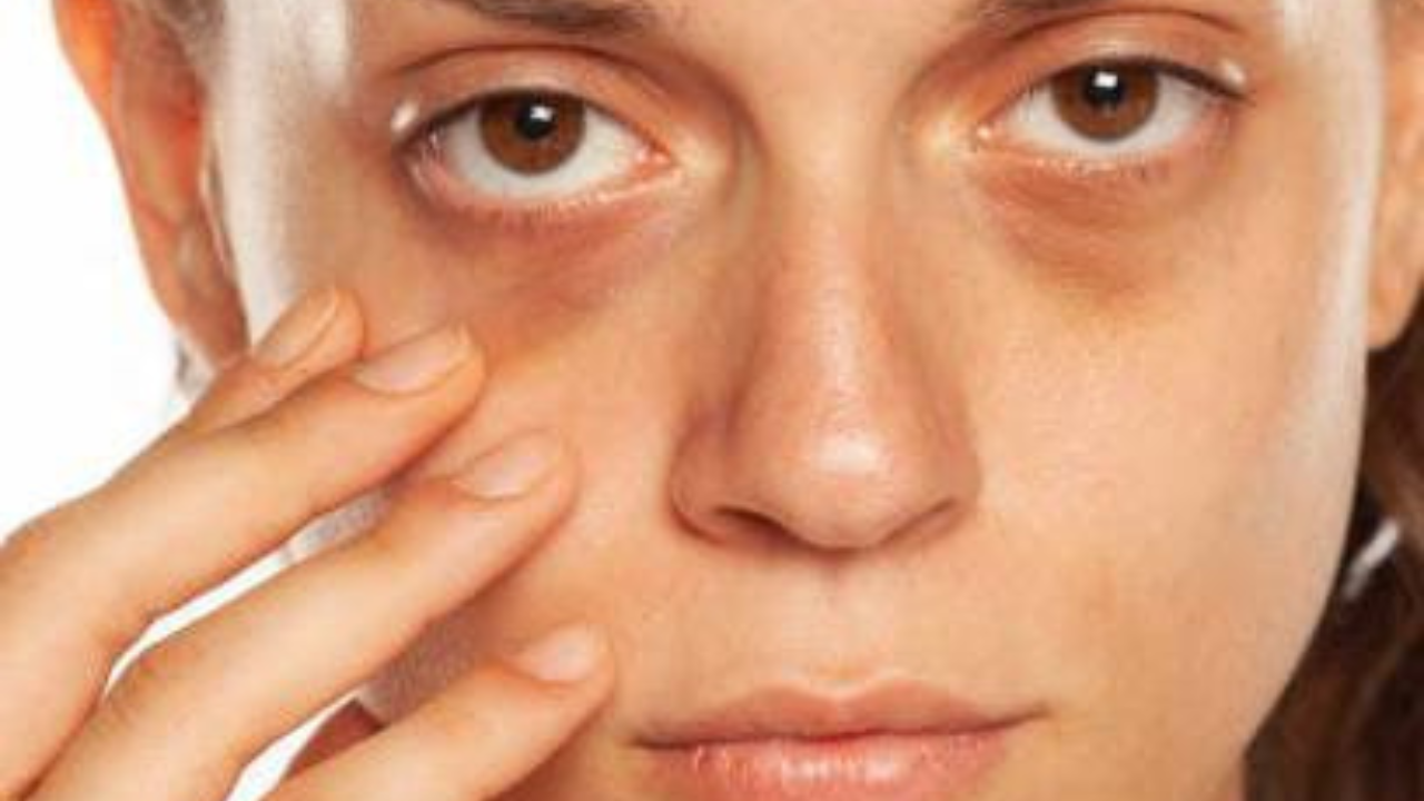 চোখের নিচের কালো দাগ ও মুখের উজ্জ্বলতা কমে যাচ্ছে?