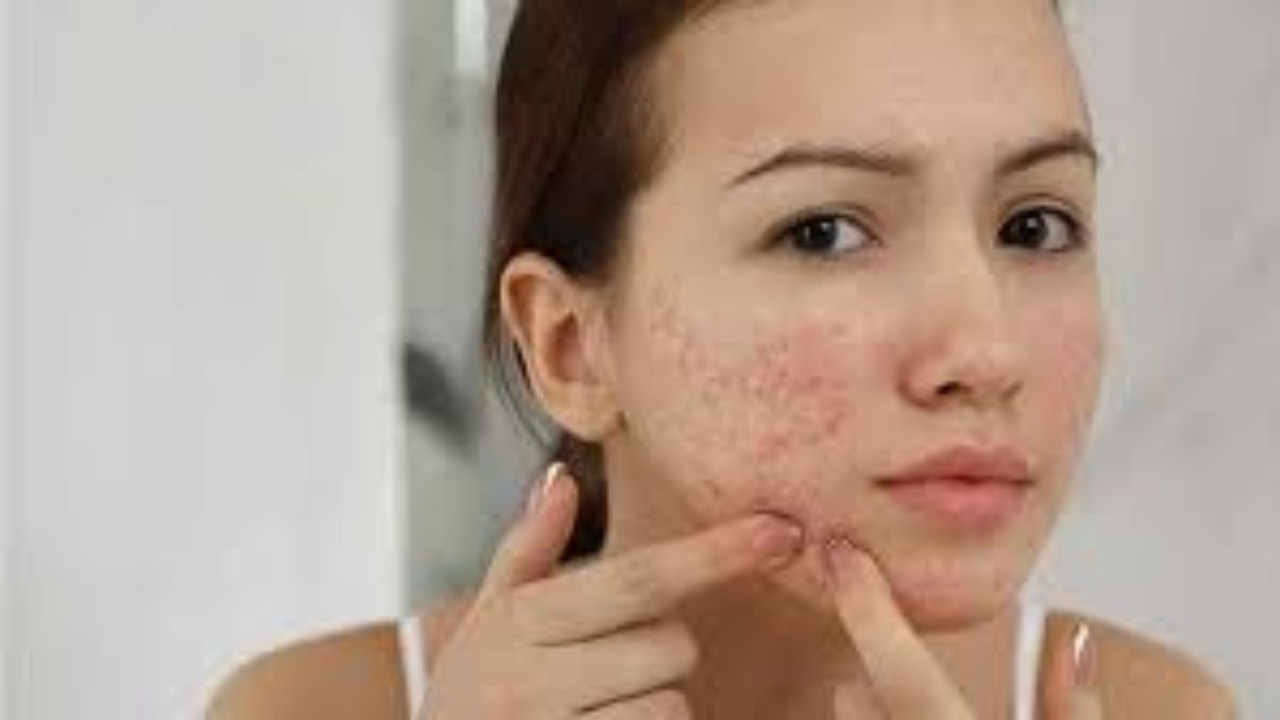 শীতকালে মুখে ব্রণ ও ত্বকের সমস্যা বেড়েছে?