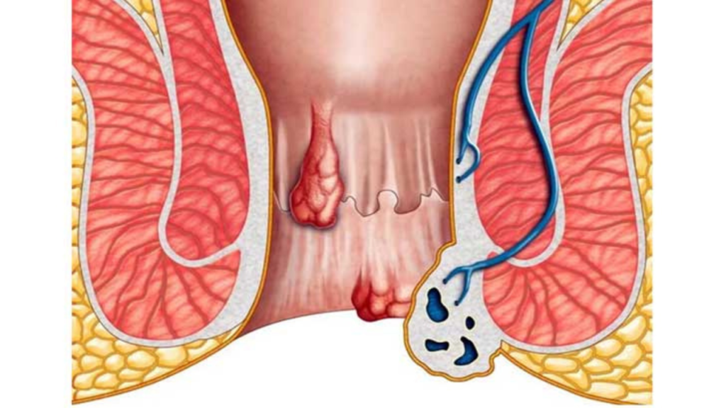 পাইলস থেকে মুক্তি পেতে
