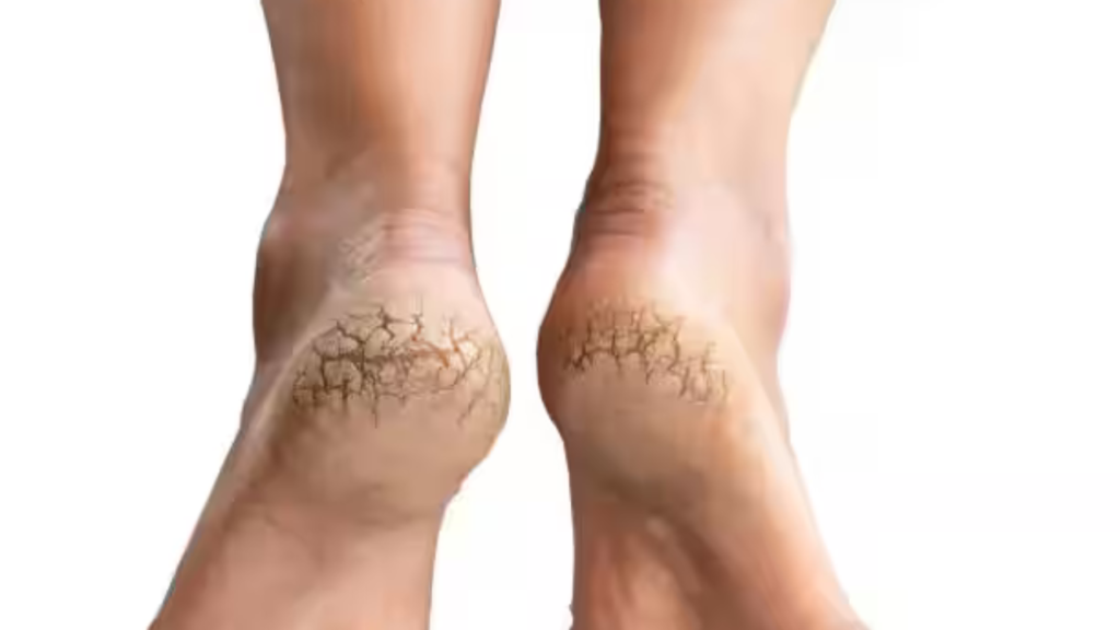 শীতে ফাটা গোড়ালি সারাতে ঘরোয়া উপায়