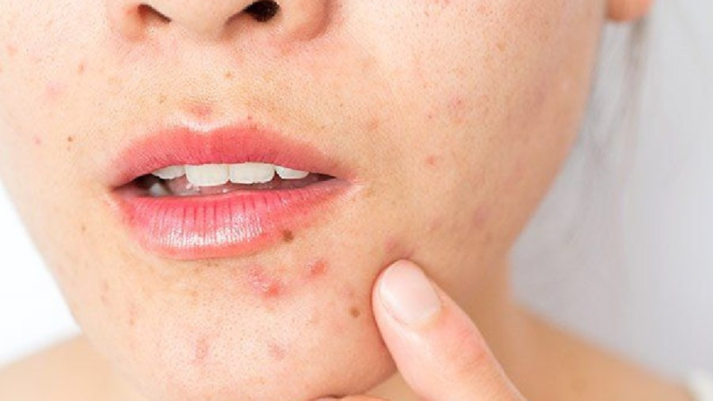মুখে ব্রণ হচ্ছে মানেই আপনার শরীরে হুরহুর করে কমছে এই ভিটামিন