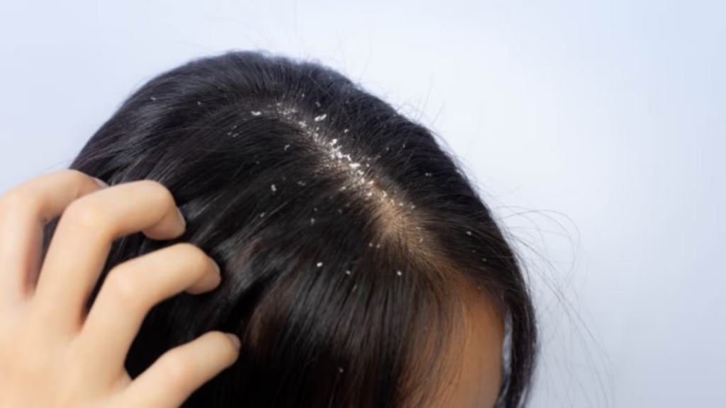 খুশকি দূর করতে নারকেল তেলের সাথে এই একটি জিনিস মেশান