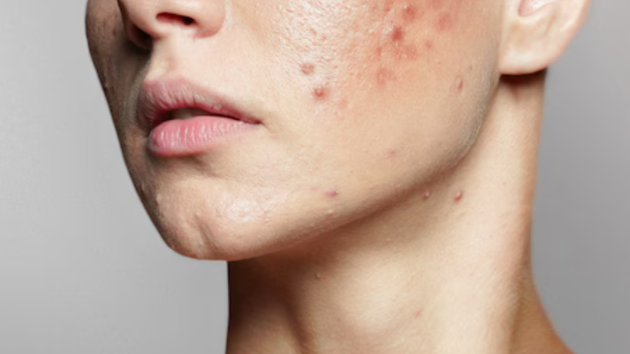 ব্রণ দূর করতে মাখুন এই ফলের বীজ! সহজ উপায়ে ফিরে পান ব্রণ বিহীন উজ্জ্বল ত্বক