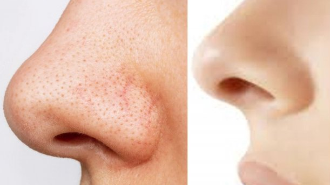 ব্রন ও ব্ল্যাকহেডস এর সমস্যা এক নিমেষে হবে ছু মন্তর কিভাবে করবেন জেনে নিন