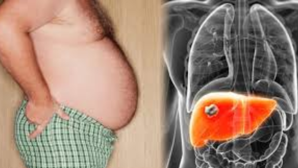 ফ্যাটি লিভার হয়েছে কিভাবে জানবেন? হলে কিভাবে সারাবেন রইল সহজ কিছু টিপস