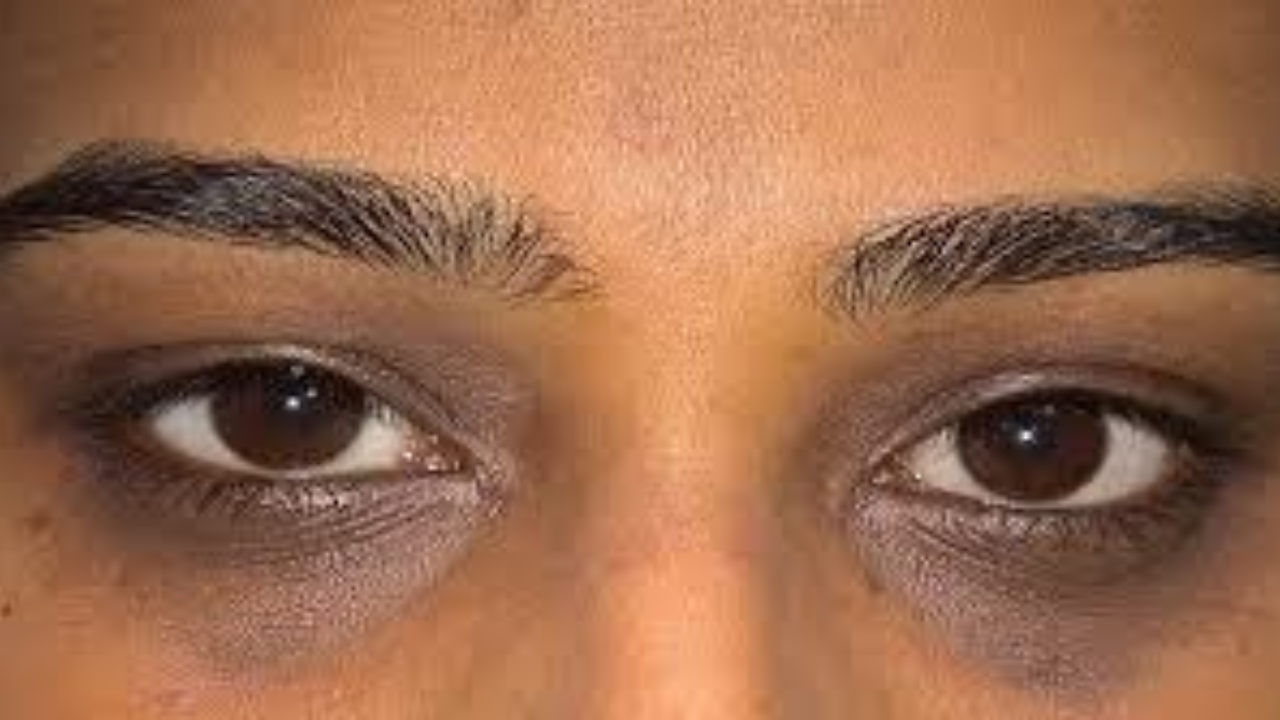 চোখের তলায় কালো দাগ থেকে চিরতরে মুক্তি পান এই ঘরোয়া মাস্কের মাধ্যমে