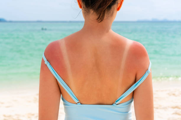 Heat Rash , SunBurn and Tan