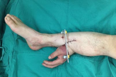 150724170238-xiangya-hospital-severed-hand-reattach-7.jpg
