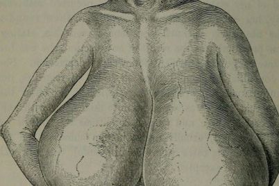 breast-hypertrophy.jpg