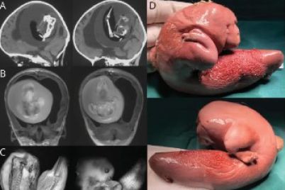 fetus-fetu.jpg